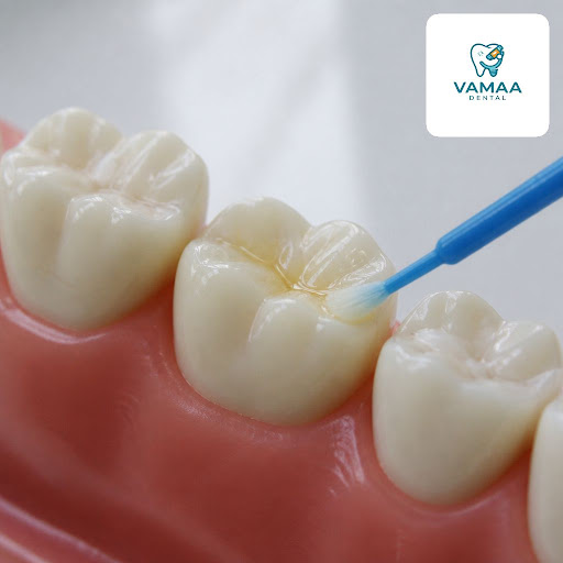 Fluoride varnish is one of the simplest and most effective ways to shield your teeth from cavitie… post image