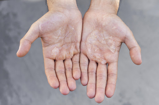 Understanding Palmoplantar Keratoderma: Managing Thickened Skin with Care post image