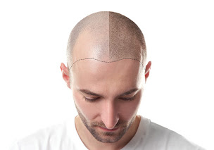 Photo n°1 de SMP Solution, tricopigmentation - micropigmentation capillaire à Arçonnay (Clinique de transplantation de cheveux)