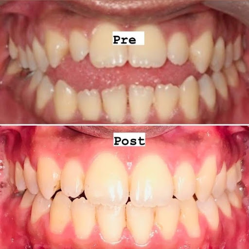 Get aligners at very affordable price. Happy smiles post image