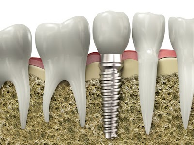 Photos of Dental implants | Dr. Ricardo Molina