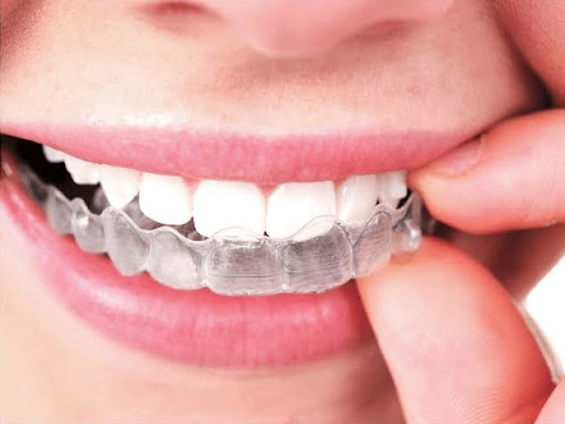 10 K Off For Invisalign Treatment