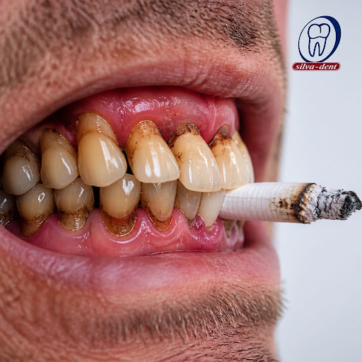 Smoking doesn’t just stain your teeth – it silently weakens your gums, bone support and overall o… post image