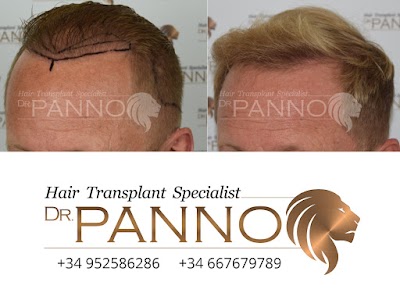 Photos of Hair Transplant Gibraltar Dr. Panno