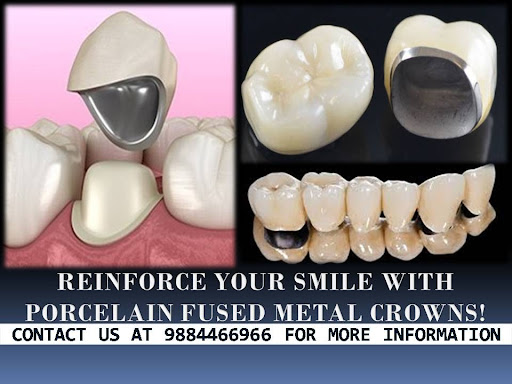 If you have a tooth that is chipped, cracked, or decayed, you will likely be recommended a dental…
