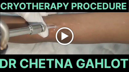 Cryotherapy is a treatment procedure in which liquid nitrogen gas is used to destruct affected ti… post image