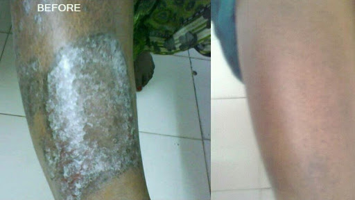 PSORIASIS TREATED BY HOMEOPATHY post image