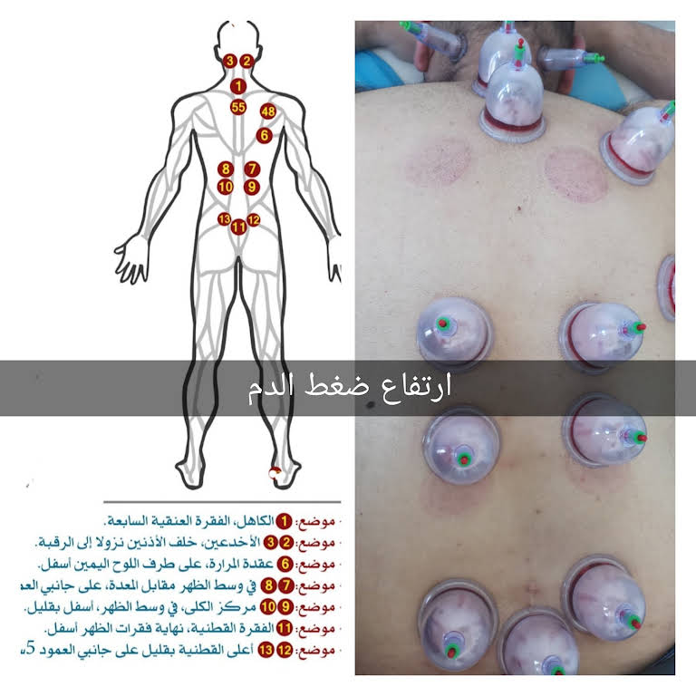 الاخدعين مركز العلاء