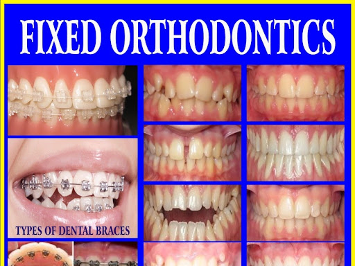 fixed braces post image