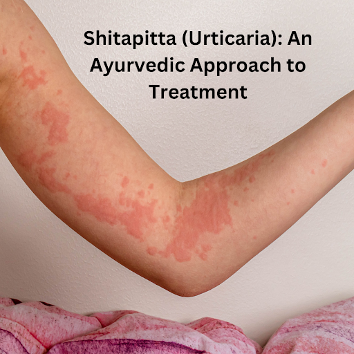 Shitapitta, known as urticaria or hives in modern medicine, is a common skin disorder characteriz… post image