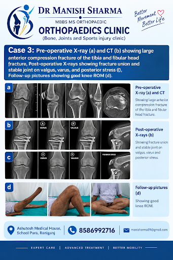 Complex Tibial Plateau Fracture Case 🦴