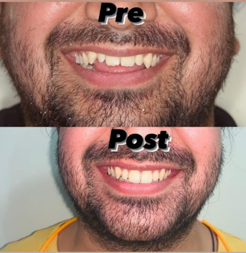 Braces treatment at affordable price post image
