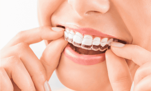 Krown Dental - Dentist Merrylands - Thumbnail