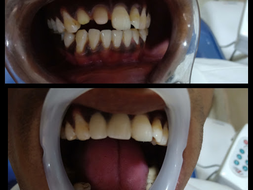 PFM crown post image