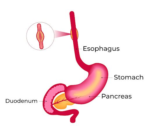 Esophageal dilatation is a medical procedure used to widen a narrowed area of the oesophagus, the… post image