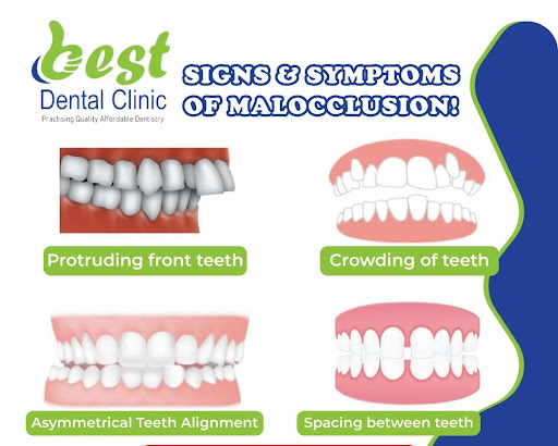 There are some Signs and Symptoms of Malocclusion such as protruding front teeth, crowding of tee… post image