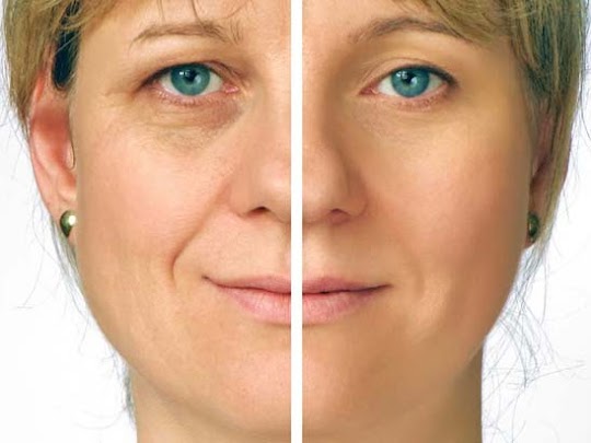 Botox Treatments For Wrinkles