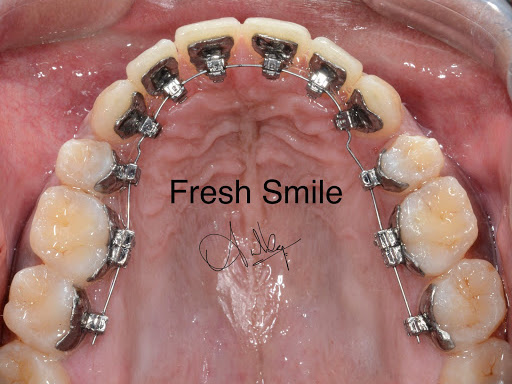 Top Orthodontist in Trivandrum for braces,Invisalign