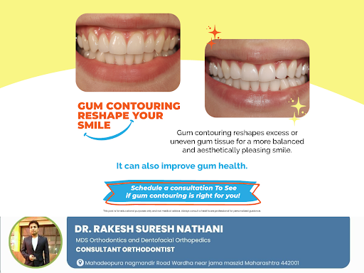 Gum contouring is a cosmetic procedure that reshapes uneven or excess gum tissue, creating a more… post image