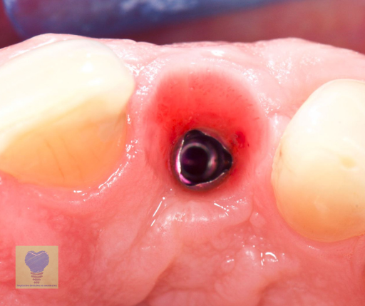 Implantes Dentales en Monterrey Dr Xavier Madrigal - Thumbnail
