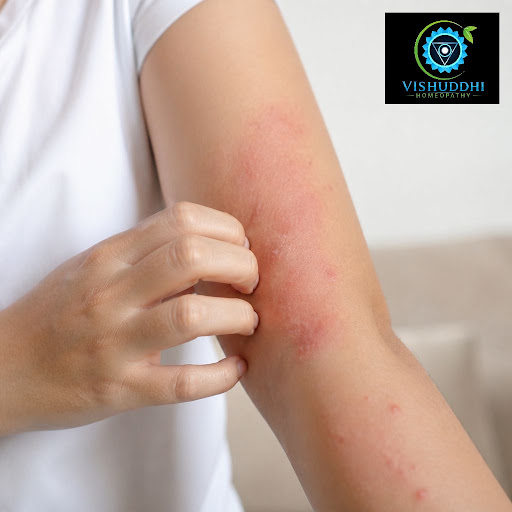 Struggling with recurring rashes, itching, or allergic rhinitis that just keeps coming back? At H… post image