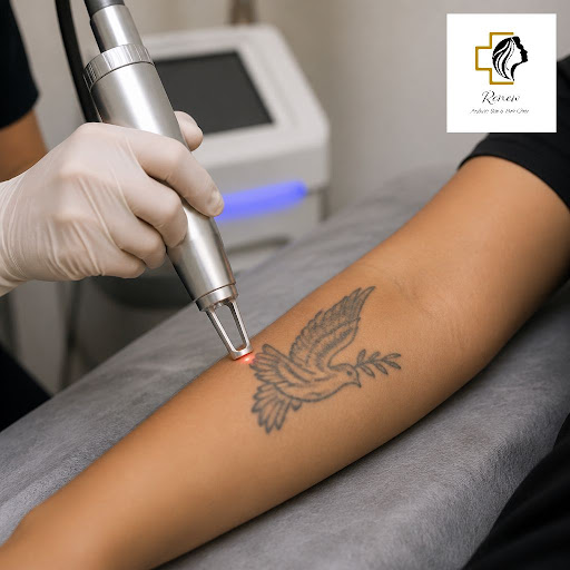 Thinking about clearing an old tattoo and giving your skin a fresh start? At Renew Aesthetics in… post image