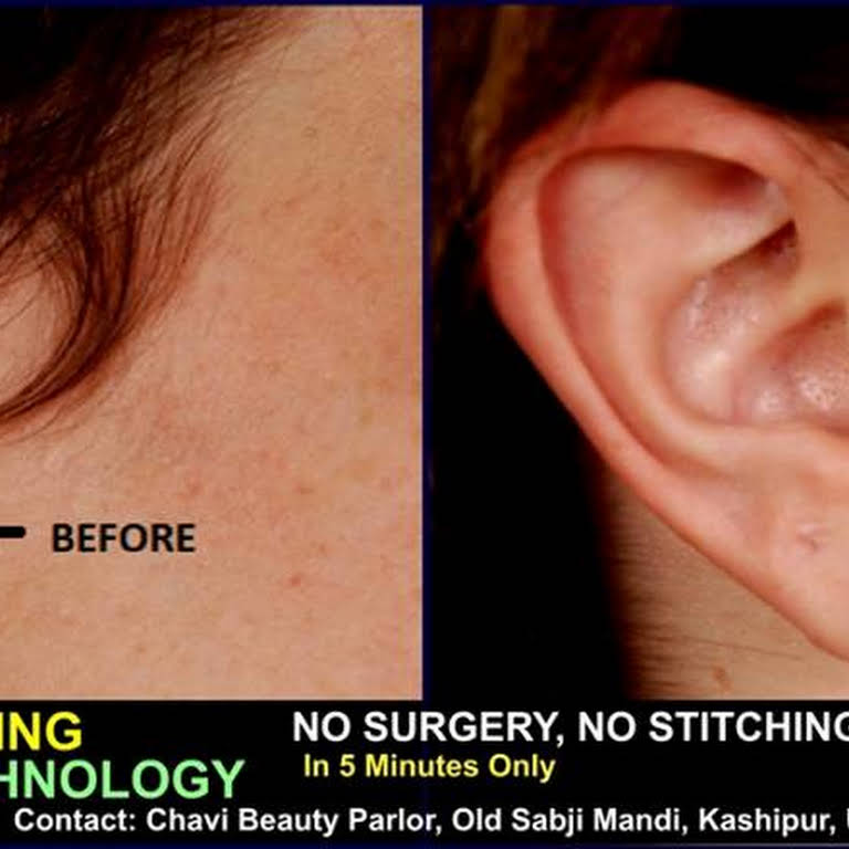 Earlobe Repair without Stitches  Earlobe repair at Aura Skin Institute  Chandigarh India