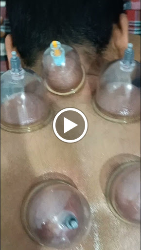 50% Off Hijama Cupping (30₹ Per Cup) Therapy post image