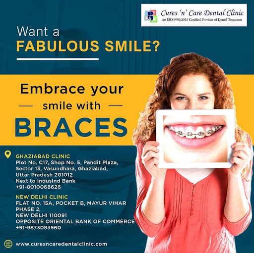Free 3D digital scan for invisible aligner