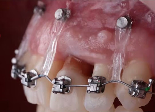 🦷 Advanced Orthodontic Treatment | आधुनिक ऑर्थोडॉन्टिक उपचार post image