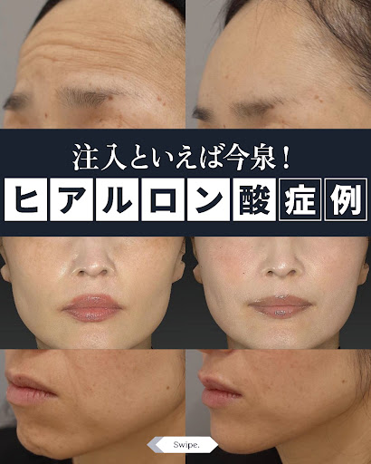 プラズマシャワー - 東京・六本木の美容皮膚科なら今泉スキンクリニック