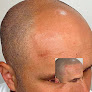 Hair transplant clinic Smp Scalp Micropigmentation By Meechididit in Lansing