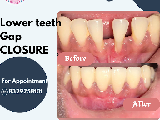 Space between your teeth can now be fixed using dental crown or cap. No need to put braces now. post image