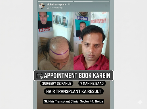 Welcome to SK Hair Transplant, the best hair transplant clinic in Noida, located in Sector-44, No…