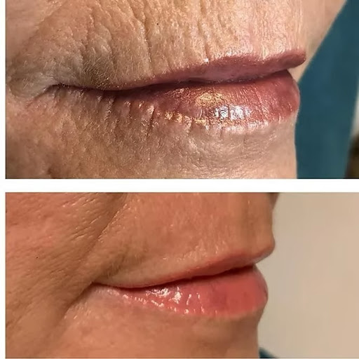 Renaissance Med Spa | Skin Care Clinic | Colorado Springs | Botox | Wrinkle Treatment | Microneedling | Face Treatment