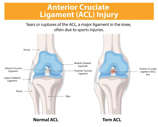 An ACL tear is a common injury that can significantly impact your mobility and quality of life. D… post image