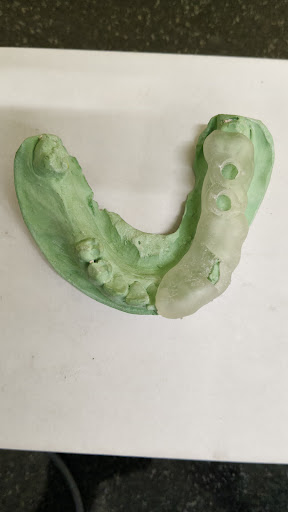 GUIDED IMPLANT SURGERY post image