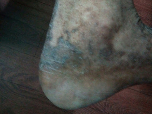 Cured within  1 week  (Dr Soumya Dey's Clinic desk) 