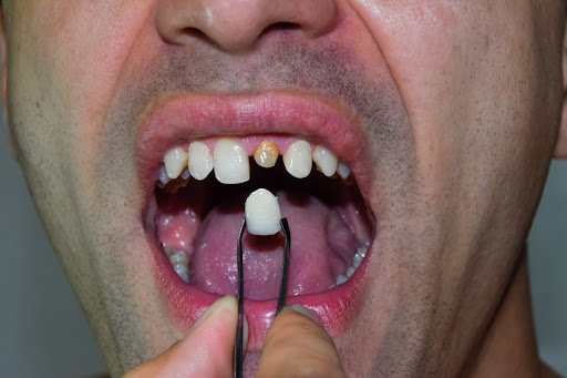 Has your tooth been damaged by a large cavity or a Root Canal treatment? A Dental Crown (ଦାନ୍ତ କ୍… post image