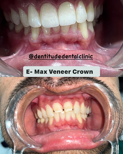 Emax Is A Beautiful, Durable Ceramic System Being Used For Porcelain Veneers And Crowns. post image