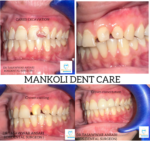 Management of an anterior tooth involving caries excavation, root canal treatment, and post-endod…