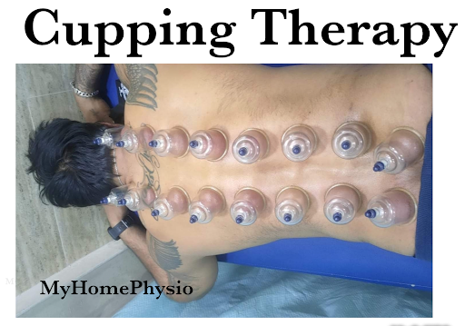Relieve Pain and Revitalize Your Body with Cupping Therapy at My Home Physio, Vikhroli East post image
