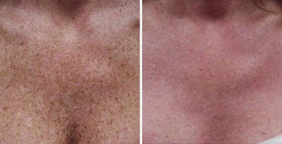 Photos of Epilution Med Spa