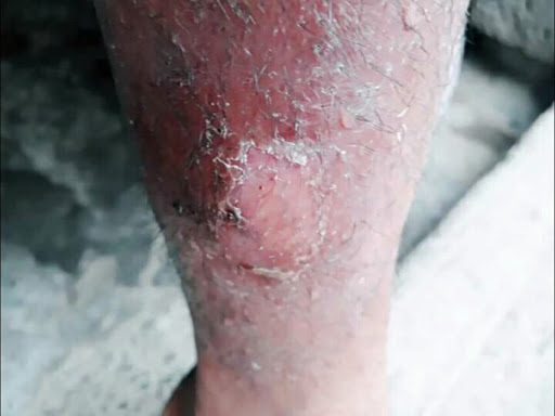 Cured within 3 weeks (Dr Soumya Dey's Clinic desk)  post image