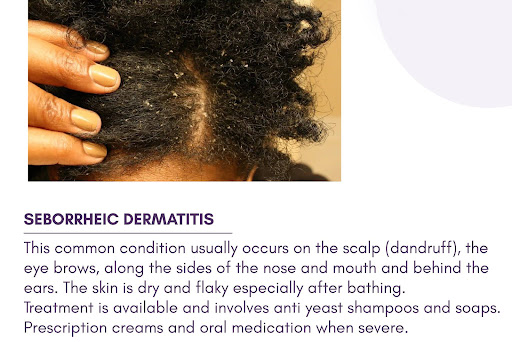 🔹 SEBORRHEIC DERMATITIS