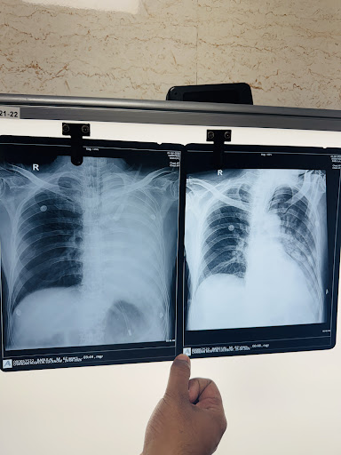Lung collape patient recovery in just 2 sessions