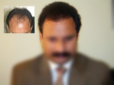 Aneels Hair Transplant islamabad