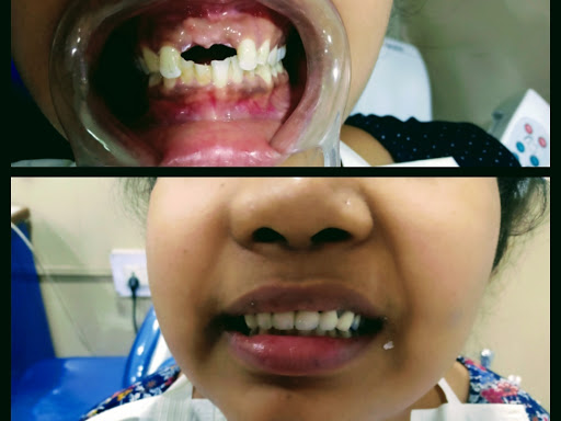 Fixed prosthesis. post image