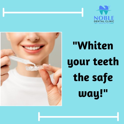 Looking for a whiter, brighter smile? At Noble Dental Clinic, we offer safe and effective teeth w… post image
