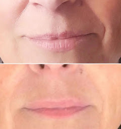 Photo n°5 de Lemniscate Aculifting à Nice (Institut de massages)